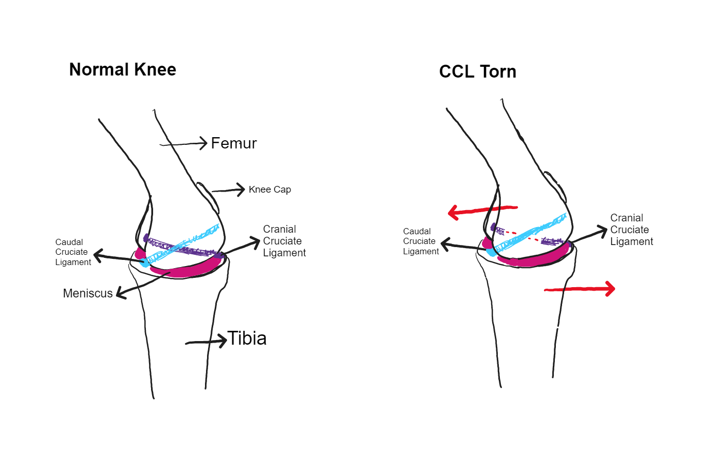 Figure 1 - Normal vs Torn CCL